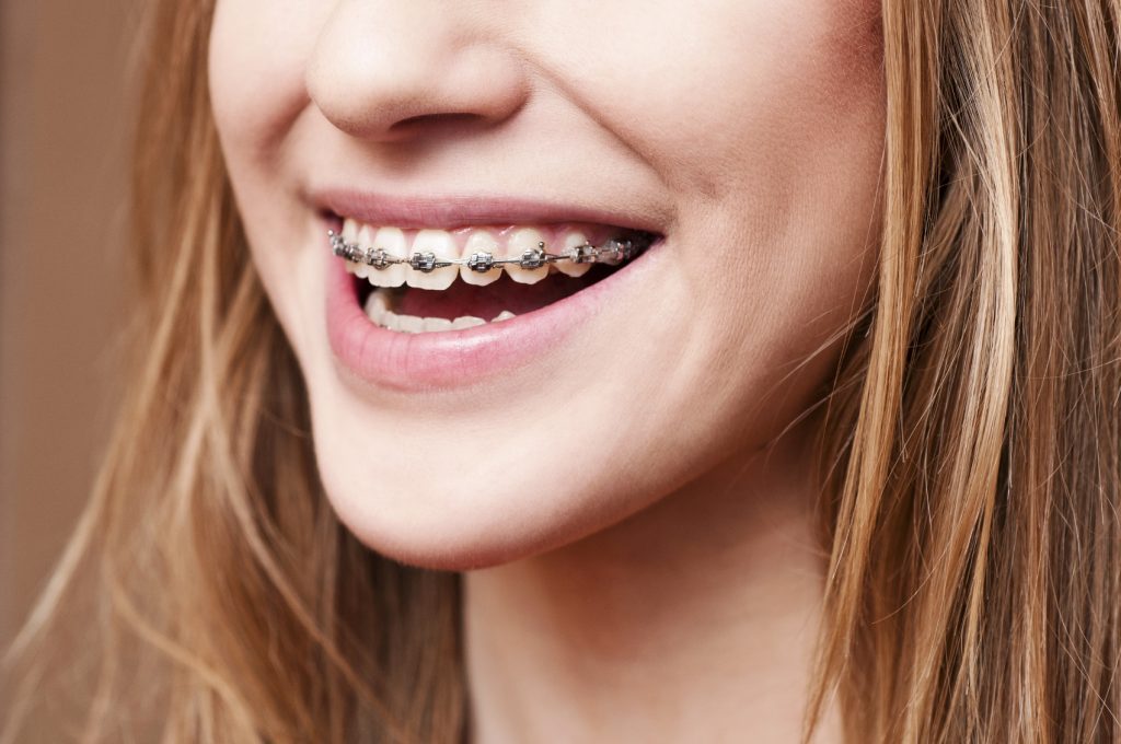 girl wearing a braces